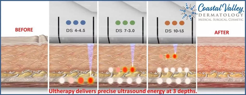 How Ultherapy focused ultrasound works on SMAS fascia layer