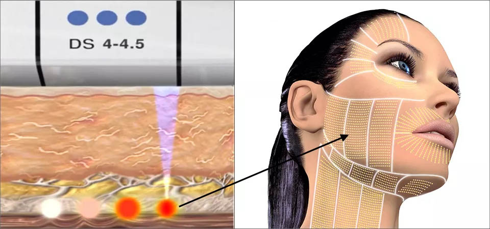 How Ultherapy ultrasound energy penetrates SMAS fascia for skin tightening