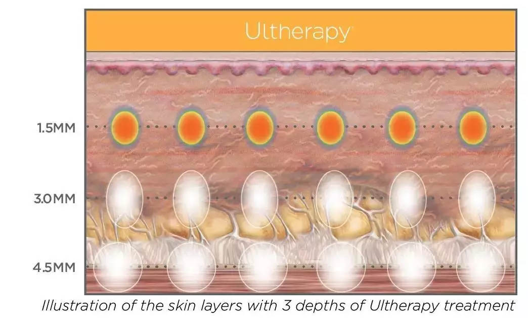 Ultherapy treatment depth diagram showing 1.5mm 3mm 4.5mm precision focusing