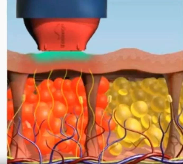 Thermage radiofrequency treatment principle and how it works on SMAS fascia layer