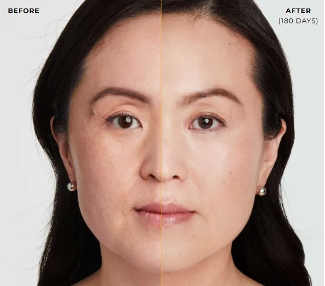Authentic Ultherapy treatment timeline and results