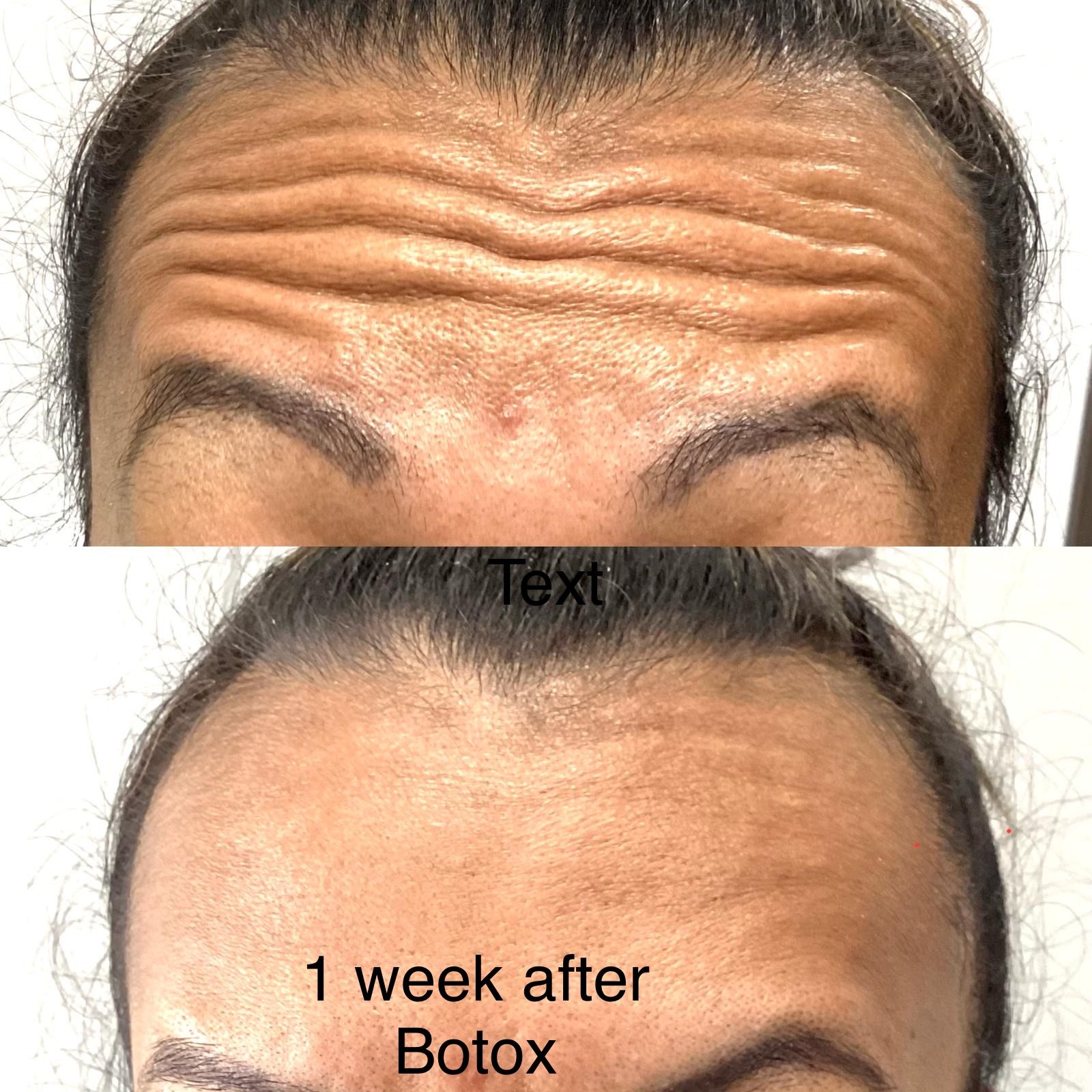 Before Botox treatment showing forehead lines