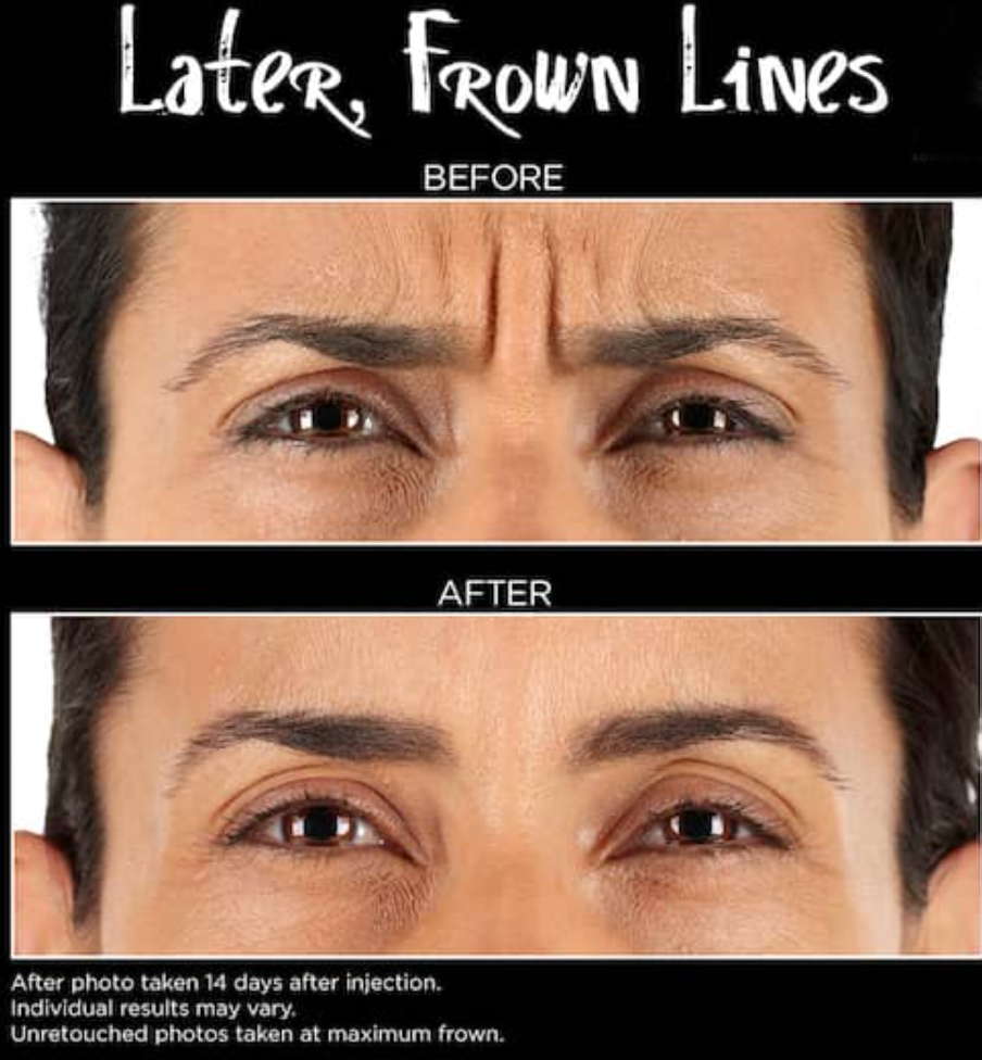 After Botox treatment showing smoothed brow