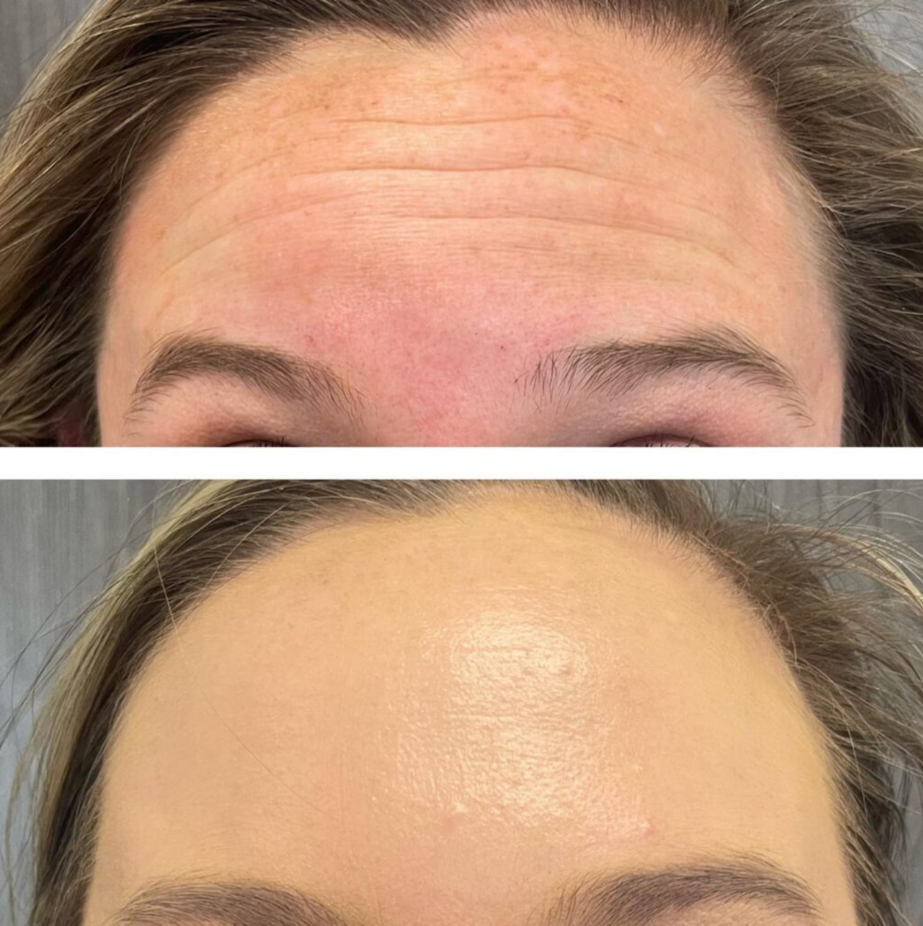 Before and after Botox treatment showing crow’s feet reduction