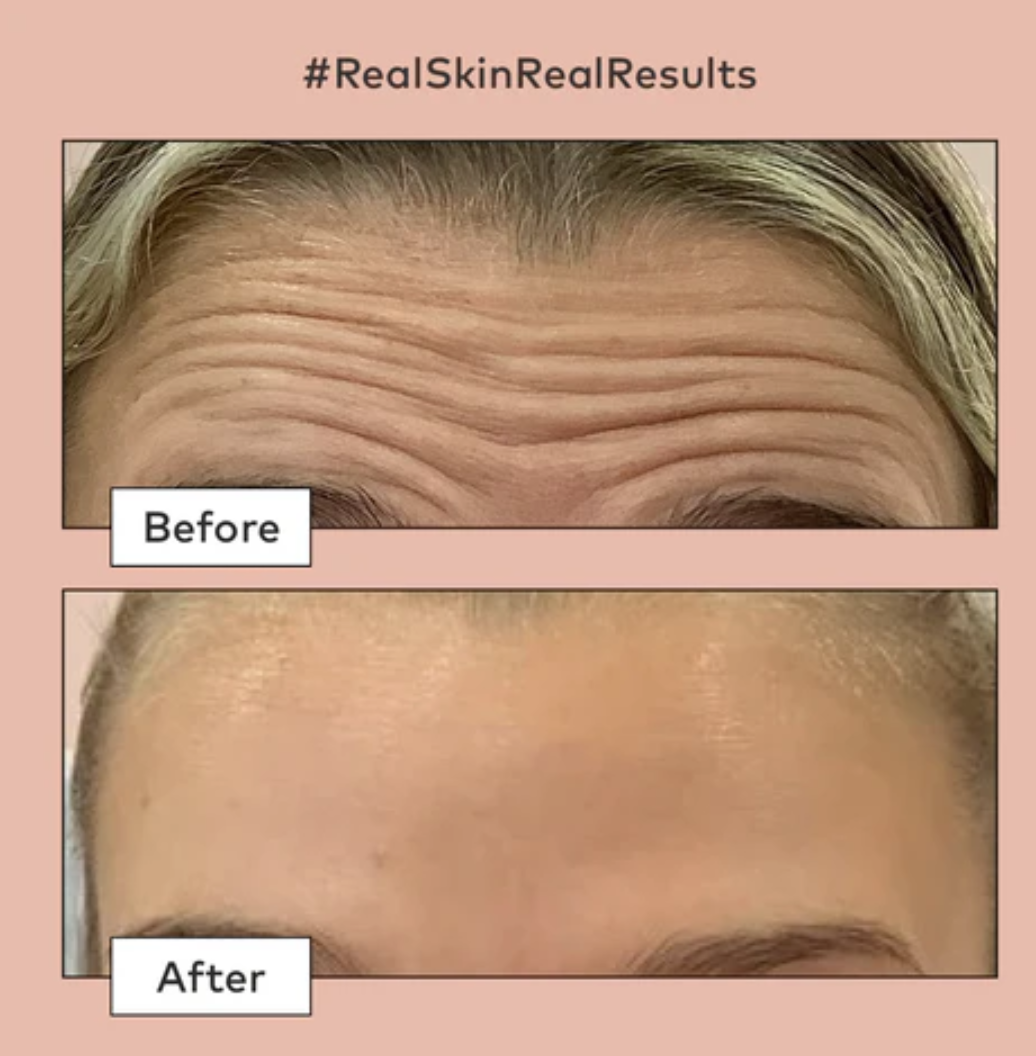 After Botox treatment showing natural-looking results