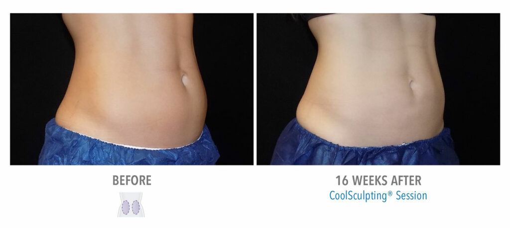 CoolSculpting Elite before and after result 10