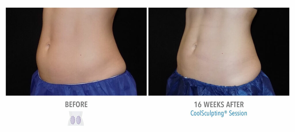 CoolSculpting Elite before and after result 11