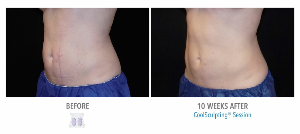CoolSculpting Elite before and after result 12