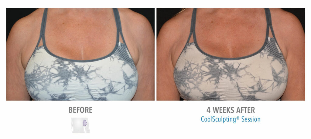 CoolSculpting Elite before and after result 20