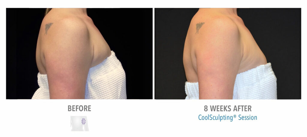 CoolSculpting Elite before and after result 21