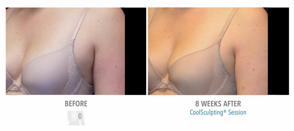 CoolSculpting Elite before and after result 22