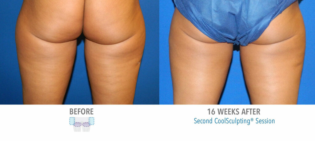 CoolSculpting Elite before and after result 30
