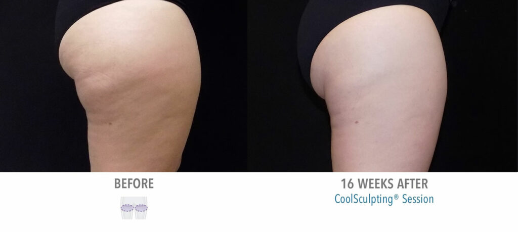 CoolSculpting Elite before and after result 31