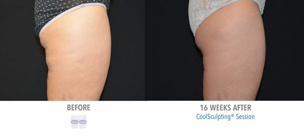 CoolSculpting Elite before and after result 32