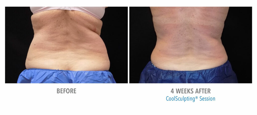 CoolSculpting Elite before and after result 40