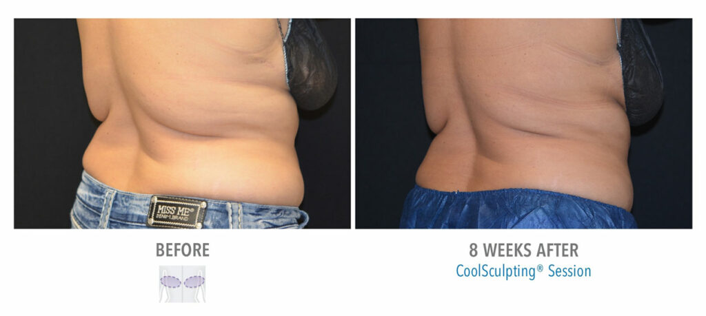 CoolSculpting Elite before and after result 41