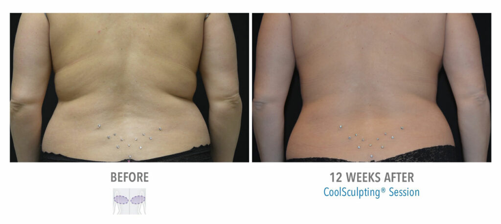 CoolSculpting Elite before and after result 42