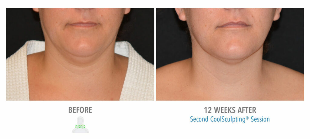 CoolSculpting Elite before and after result 50