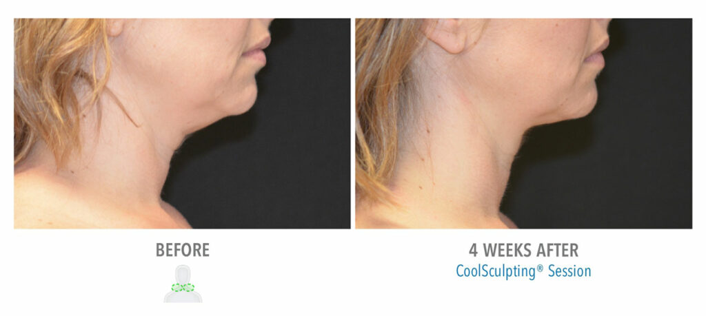 CoolSculpting Elite before and after result 51