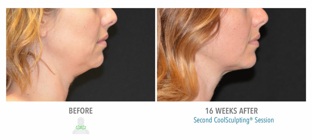 CoolSculpting Elite before and after result 52