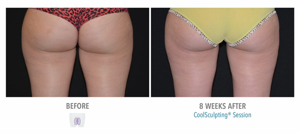 CoolSculpting Elite before and after result 60