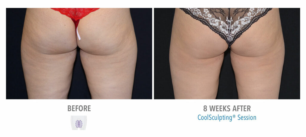 CoolSculpting Elite before and after result 61