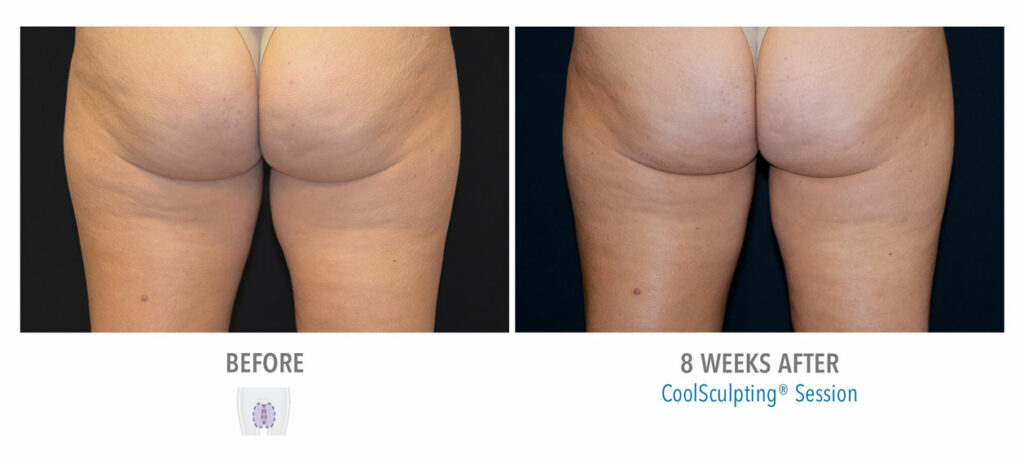 CoolSculpting Elite before and after result 62