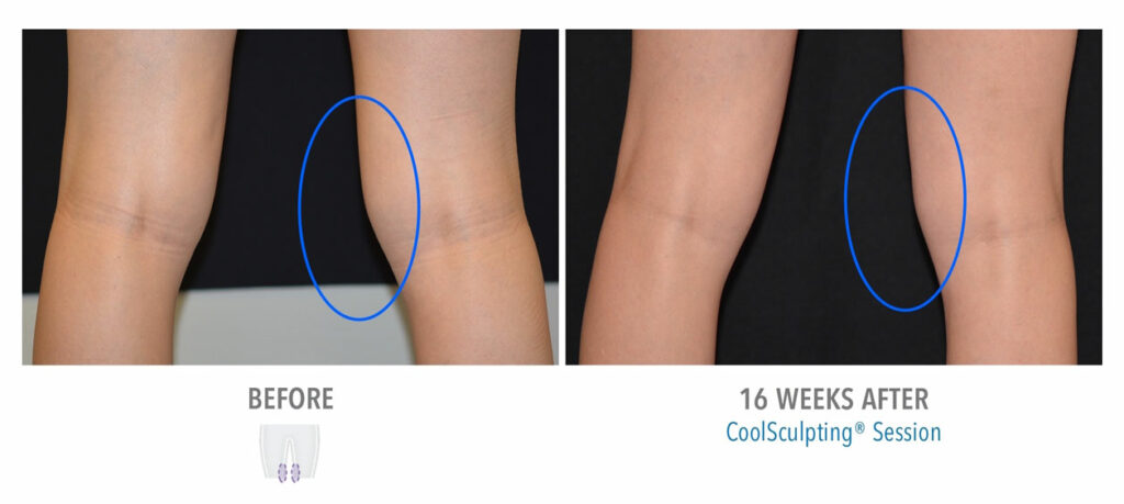 CoolSculpting Elite before and after result 70