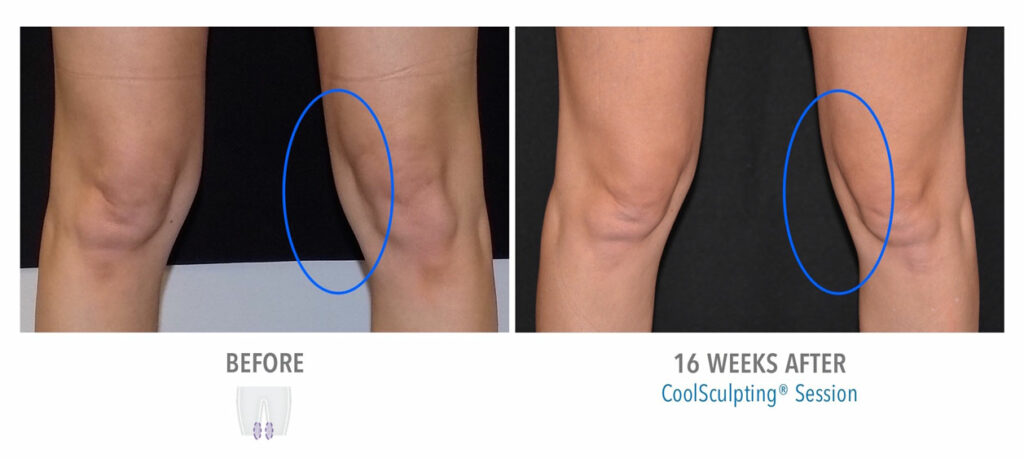CoolSculpting Elite before and after result 71