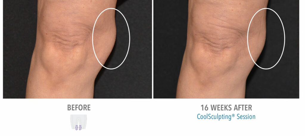 CoolSculpting Elite before and after result 72