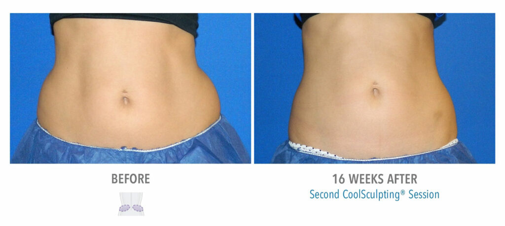 CoolSculpting Elite before and after result 80