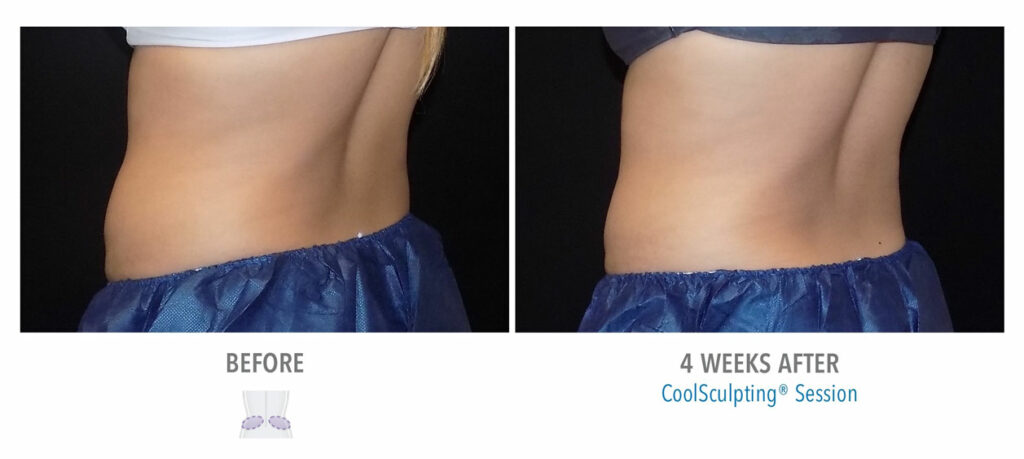 CoolSculpting Elite before and after result 81