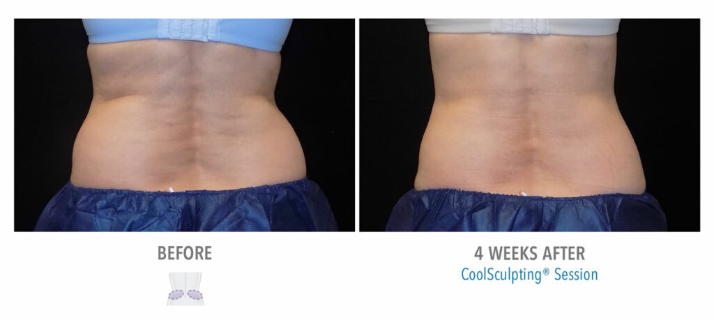 CoolSculpting Elite before and after result 82