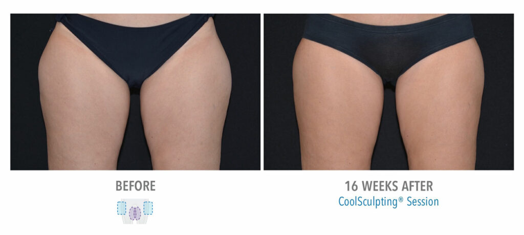 CoolSculpting Elite before and after result 90