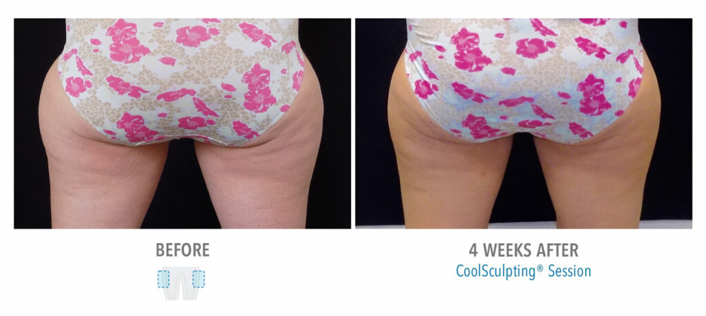 CoolSculpting Elite before and after result 92
