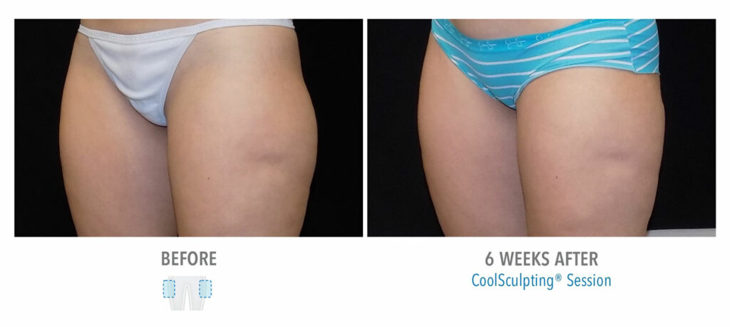 CoolSculpting Elite before and after result 93