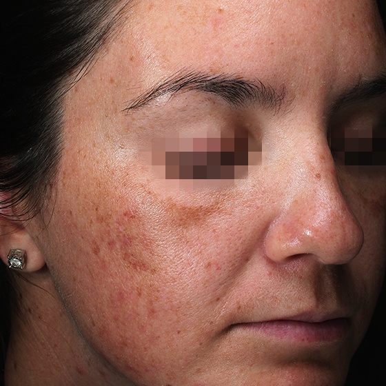 PicoSure before and after 1