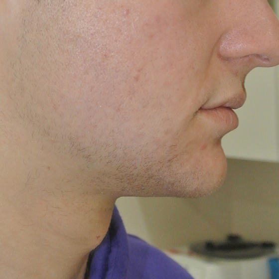 PicoSure before and after 10