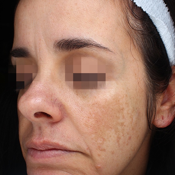 PicoSure before and after 11