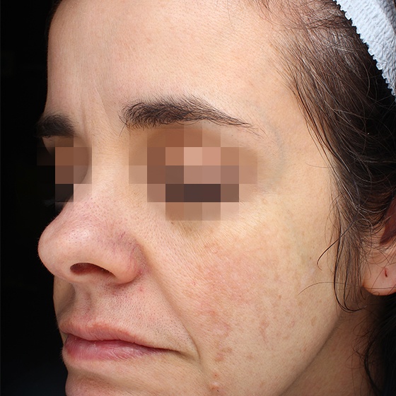 PicoSure before and after 12
