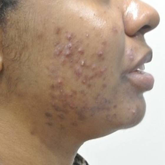 PicoSure before and after 13