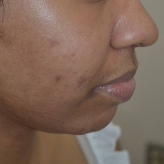 PicoSure before and after 14
