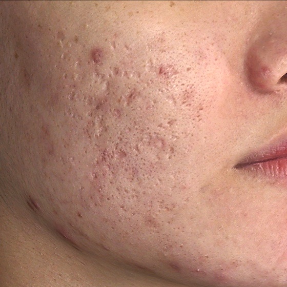 PicoSure before and after 15