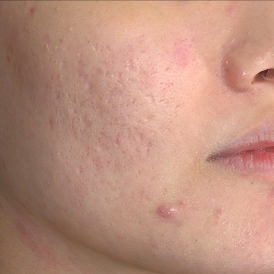 PicoSure before and after 16