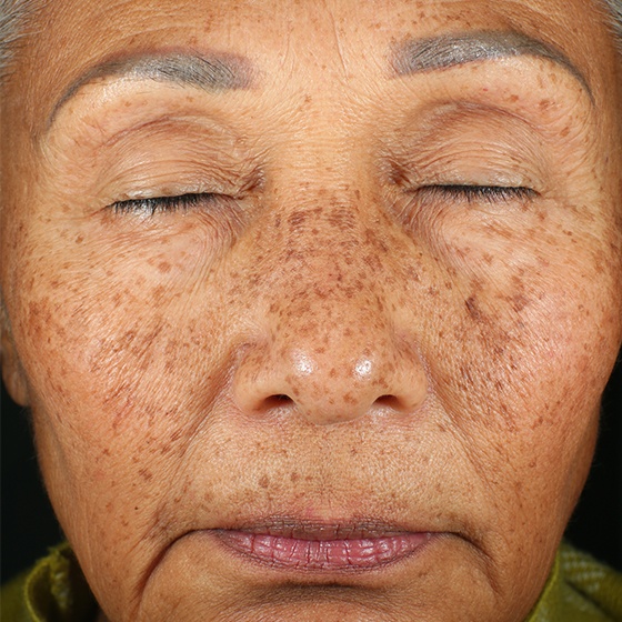 PicoSure before and after 17