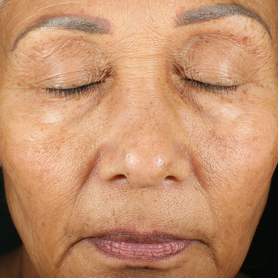 PicoSure before and after 18
