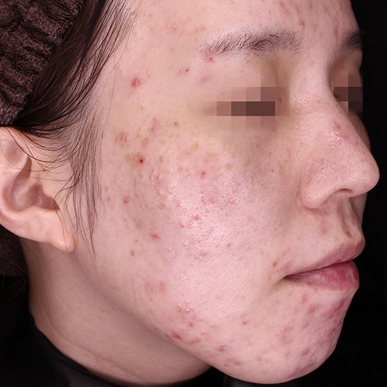 PicoSure before and after 19