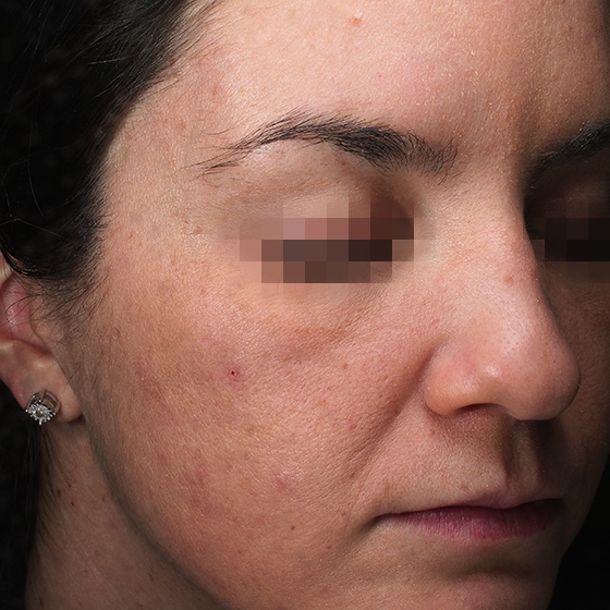 PicoSure before and after 2