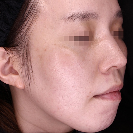PicoSure before and after 20