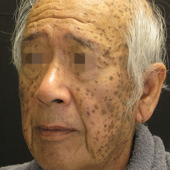 PicoSure before and after 21